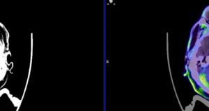 Radiofármacos innovadores permiten diagnósticos más precisos en neuro-oncología y Parkinson.