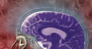 Ataque cerebrovascular: la segunda causa de muerte y principal causa de discapacidad en Colombia