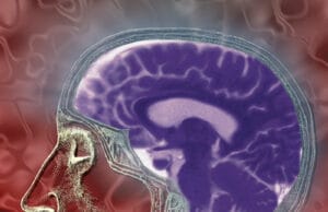 Ataque cerebrovascular: la segunda causa de muerte y principal causa de discapacidad en Colombia