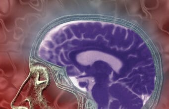Ataque cerebrovascular: la segunda causa de muerte y principal causa de discapacidad en Colombia