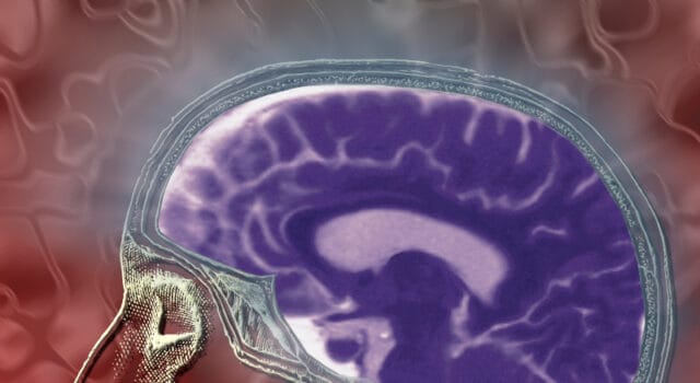 Ataque cerebrovascular: la segunda causa de muerte y principal causa de discapacidad en Colombia