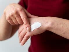 Quemaduras en diciembre: experta explica cómo tratar adecuadamente heridas leves y graves