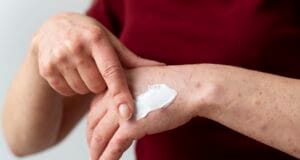 Quemaduras en diciembre: experta explica cómo tratar adecuadamente heridas leves y graves