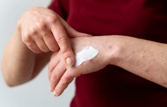 Quemaduras en diciembre: experta explica cómo tratar adecuadamente heridas leves y graves