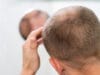 Hombres lideran 85% de consultas por caída capilar