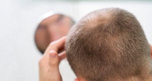 Hombres lideran 85% de consultas por caída capilar