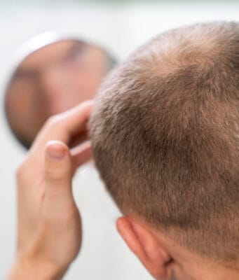 Hombres lideran 85% de consultas por caída capilar